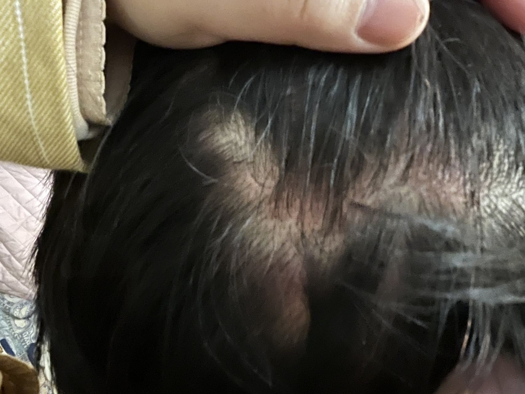 三橡树染发剂虚假宣传,严重过敏 本人在某猫旗舰店购买的三橡树染发剂