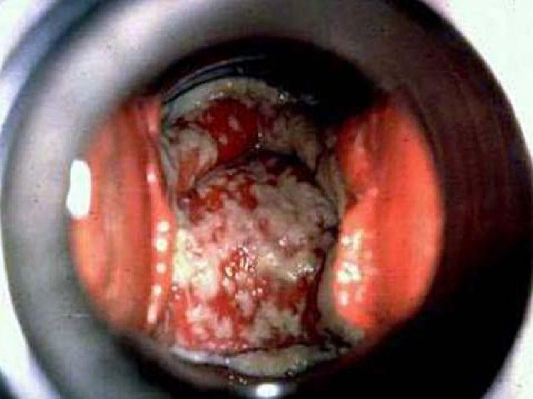 科普:一文读懂宝宝鹅口疮 96症状 鹅口疮为白色念珠菌在口腔粘膜