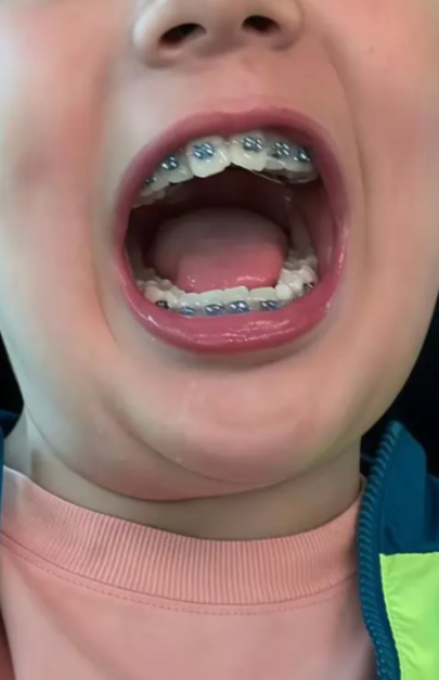 门牙越来越往外凸,这通常和两个原因有关:要么是平时有不好的口腔