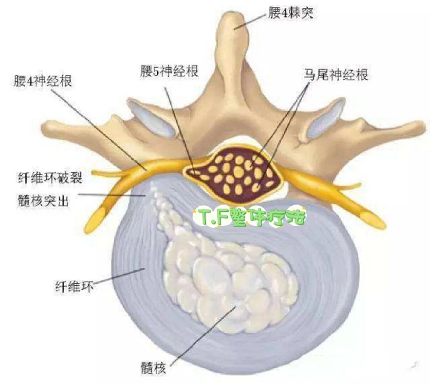 腰椎人工椎间盘图片图片