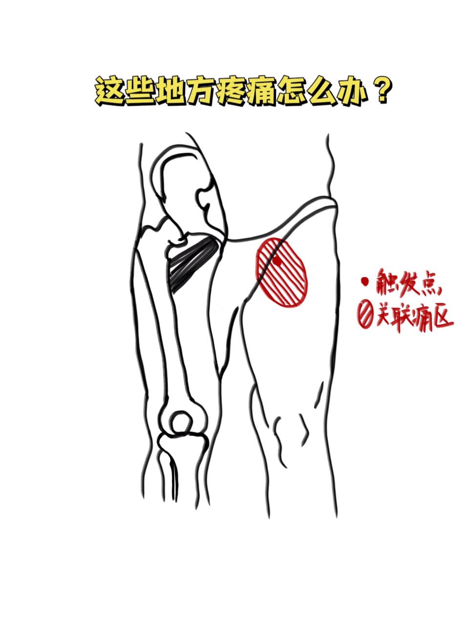 肌肉疼痛与自疗法11 大腿内侧—耻骨肌 耻骨肌是大腿内侧肌群中位妹