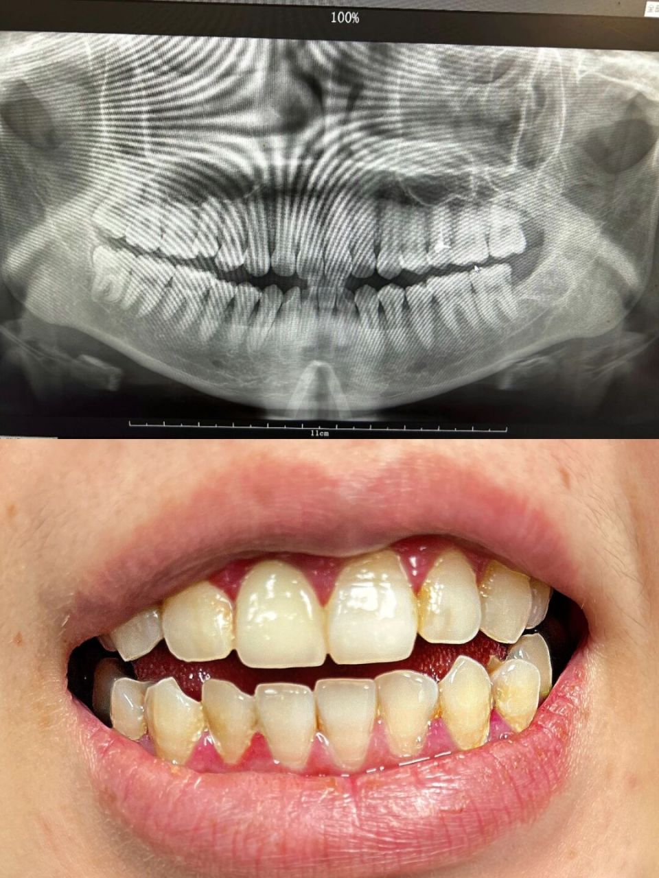 不删! 姐妹们刷到这篇真的要码住了,牙周炎的福音好吗!