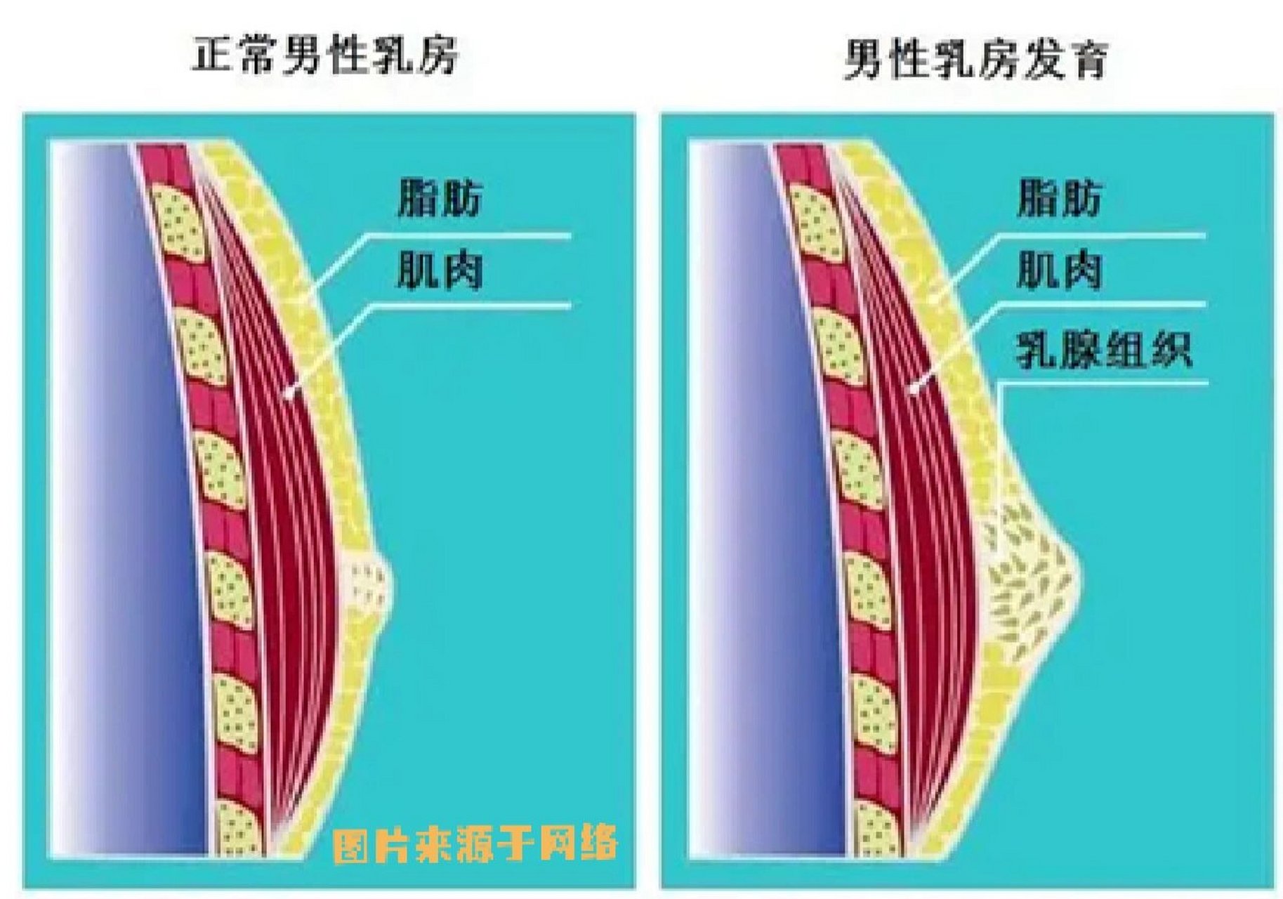 男性乳腺腺体发育图片