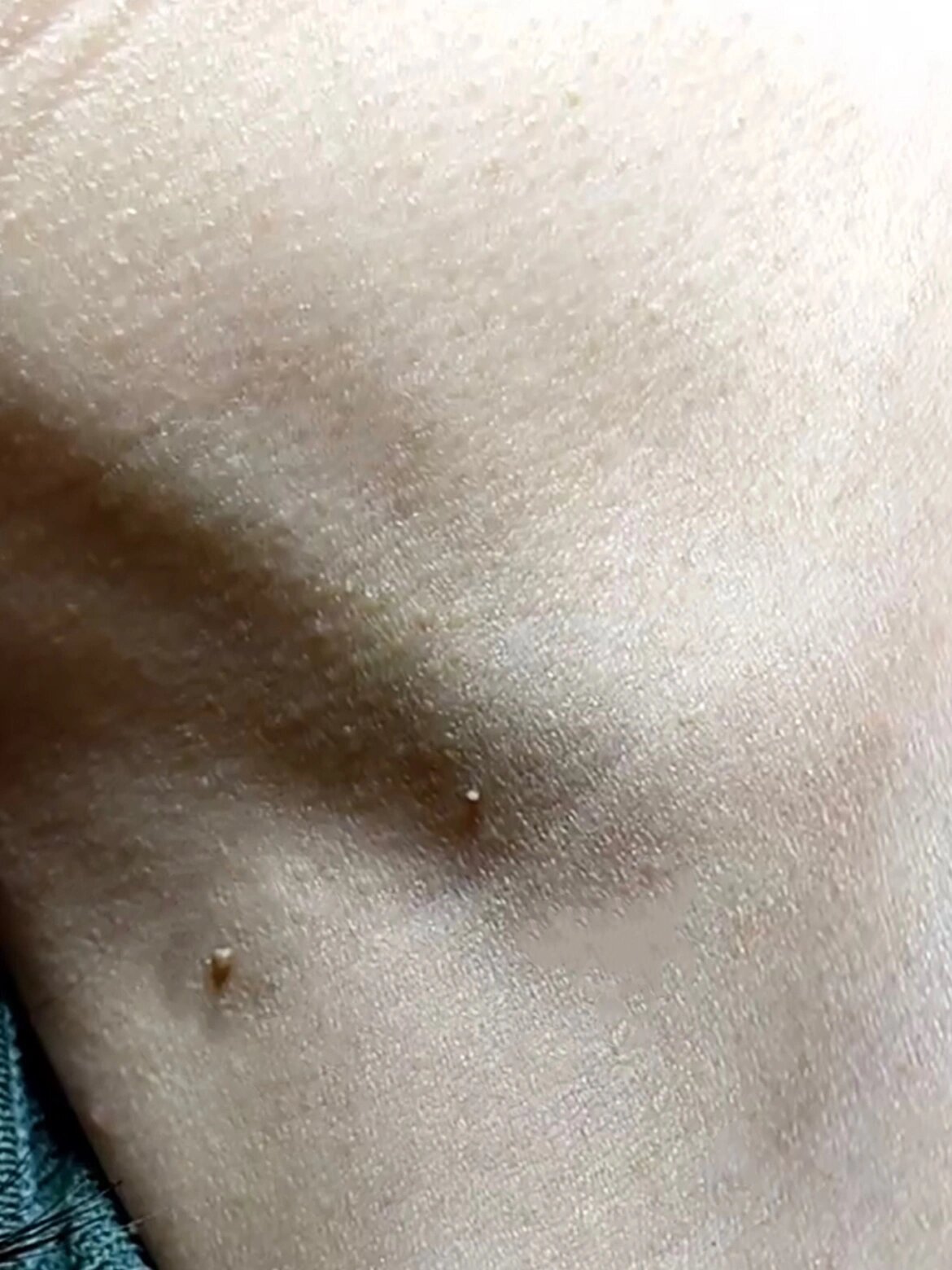 小心脖子上这些小肉揪