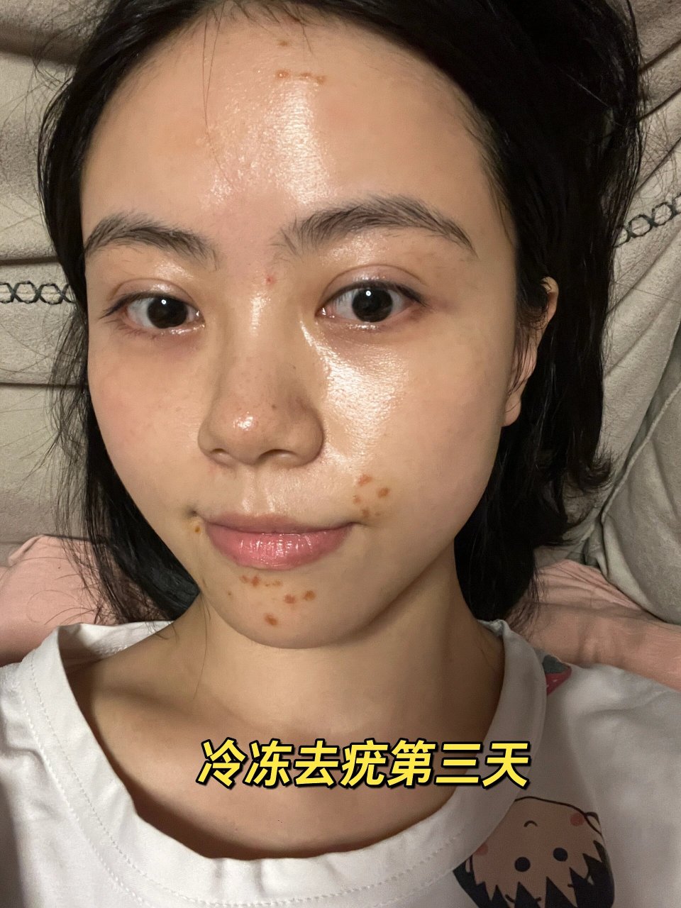 啦 脸上有闭口,我挤了以后就形成凸起状的东西,我一直以为是我增生