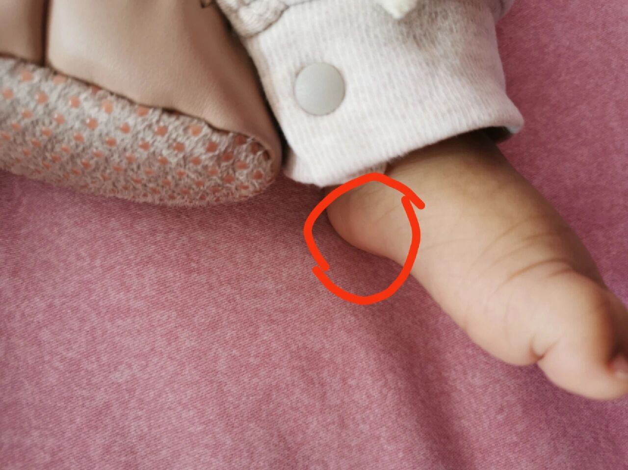 宝宝脚内侧鼓包 今天给娃穿袜子,突然发现两只脚内侧都有鼓包,可是家