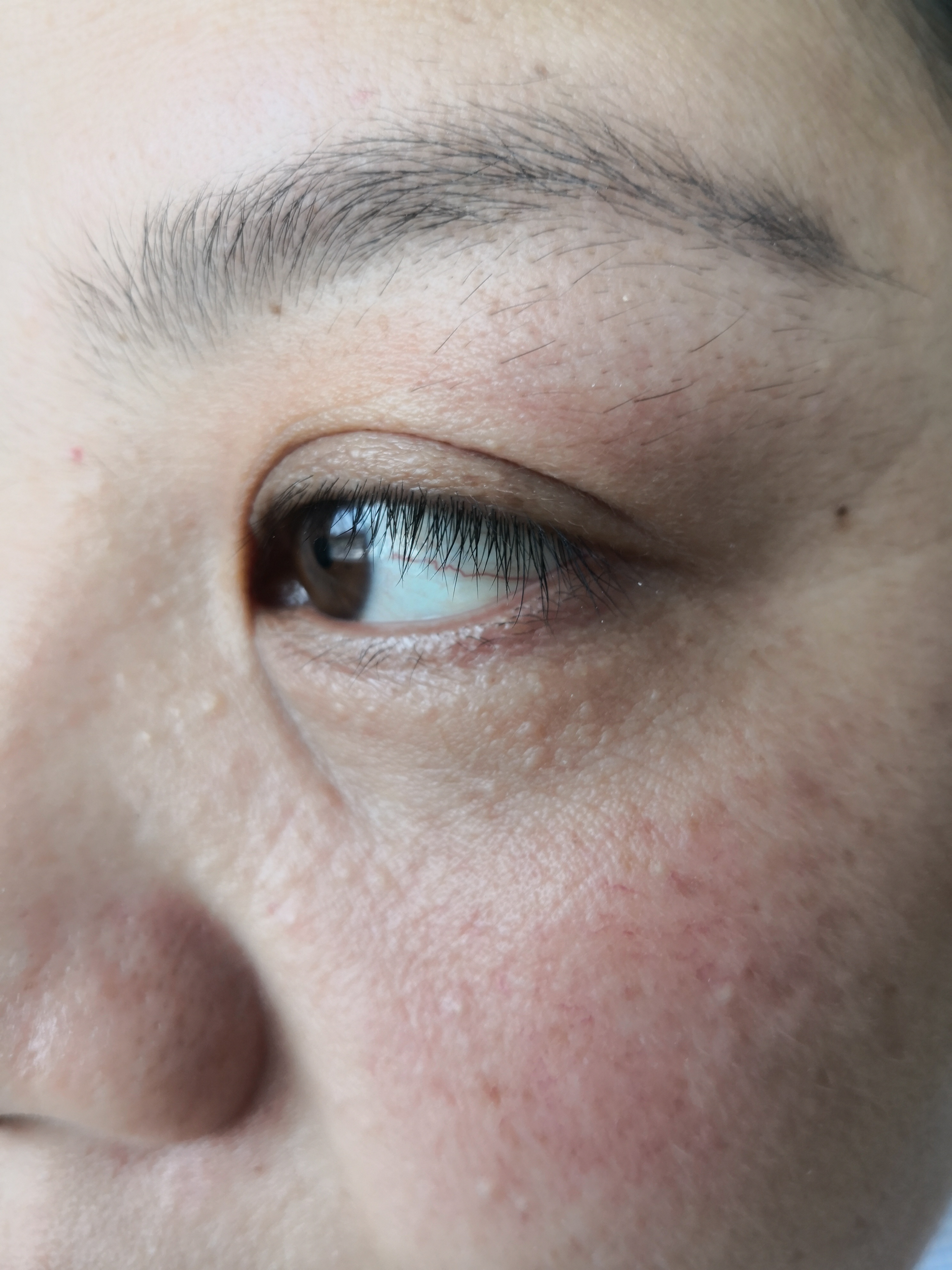 下眼睑颗粒样丘疹症状.考虑汗管瘤.可以使用激光治疗去除