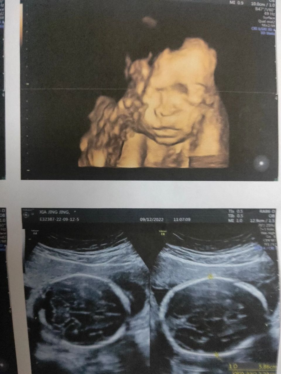 三维 胎儿心脏彩超,顺利通过啦05 心心念念做三维的日子, 期待见到