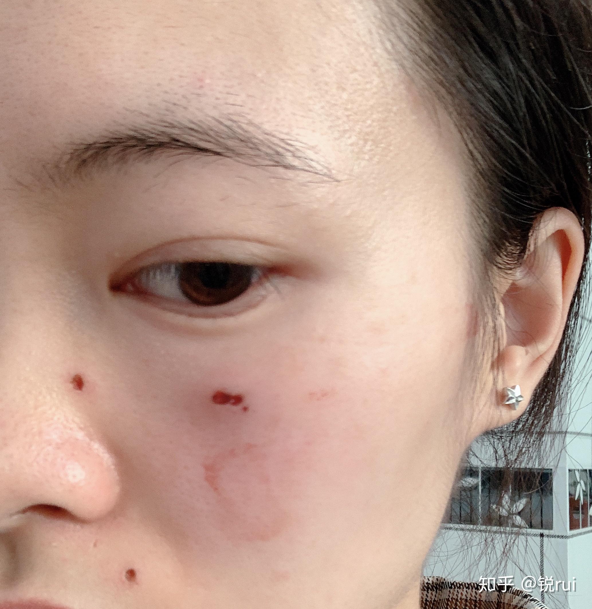 激光去痣是什么样的体验