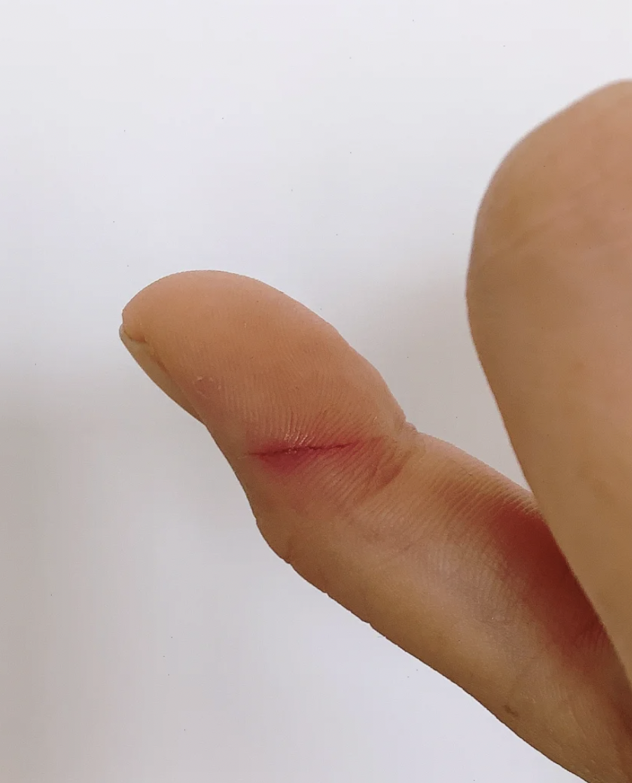 手指被带铁锈的铁丝划伤后,要马上做这几件事: