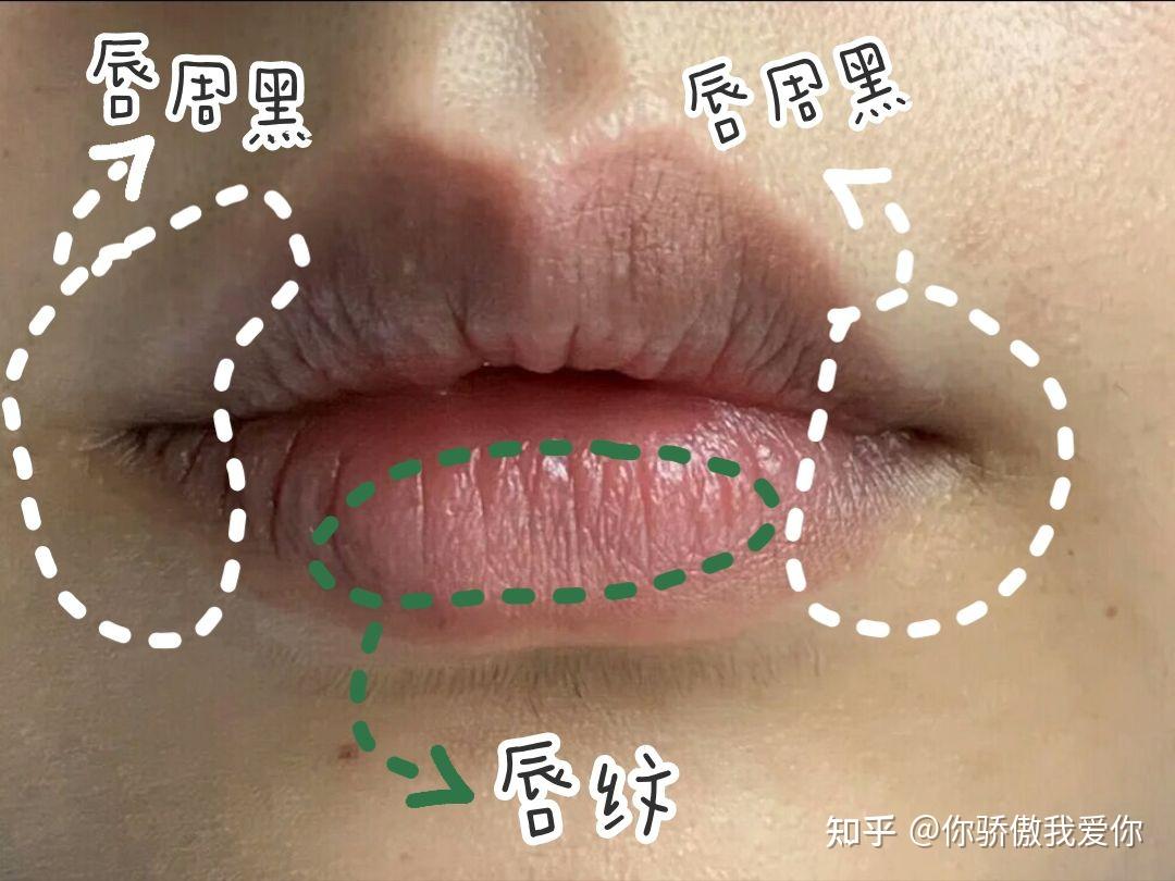 唇部有黑色素斑点原因图片