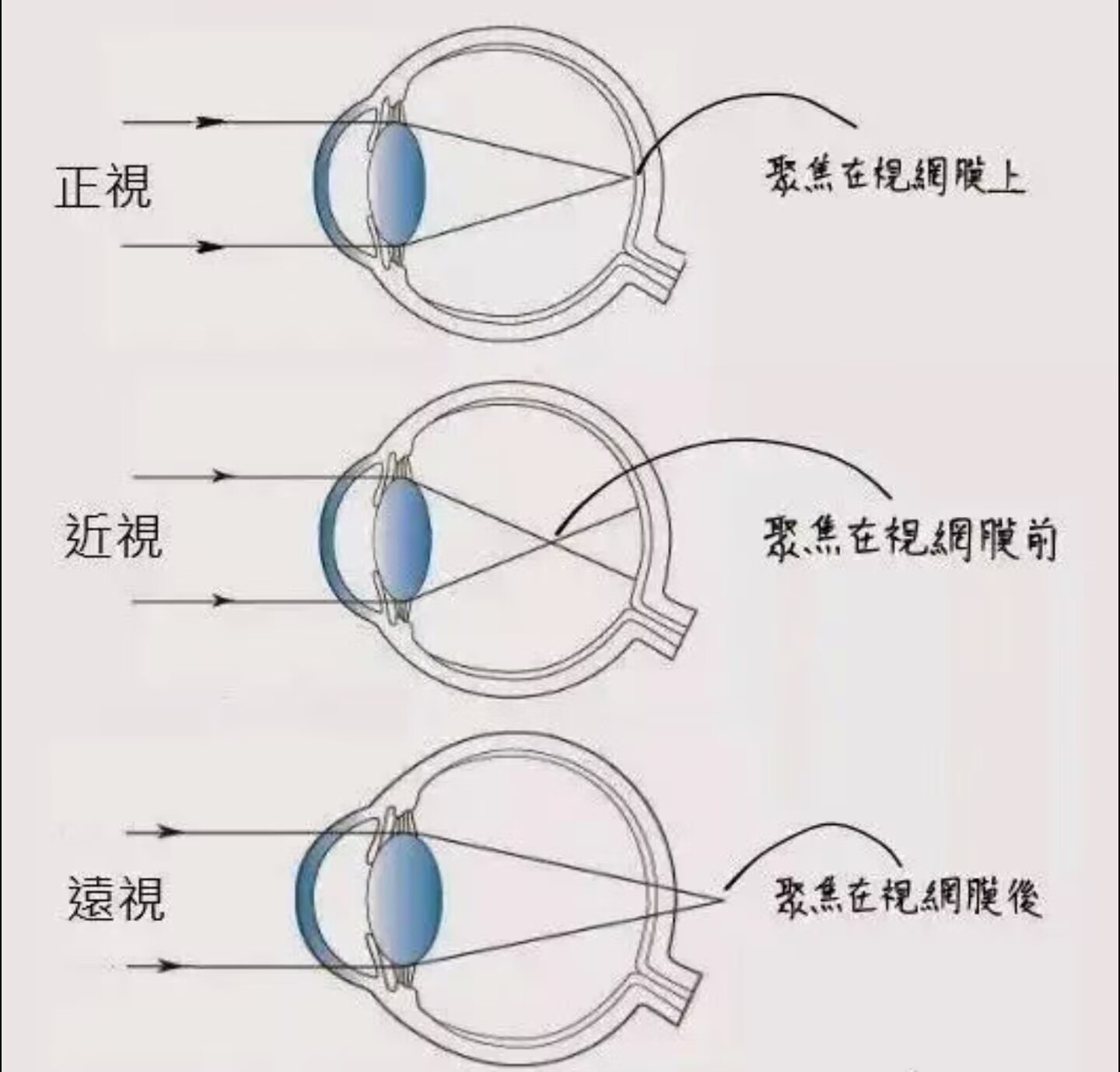 近视和远视里所说的远和近,指的并非物体跟眼睛的距离