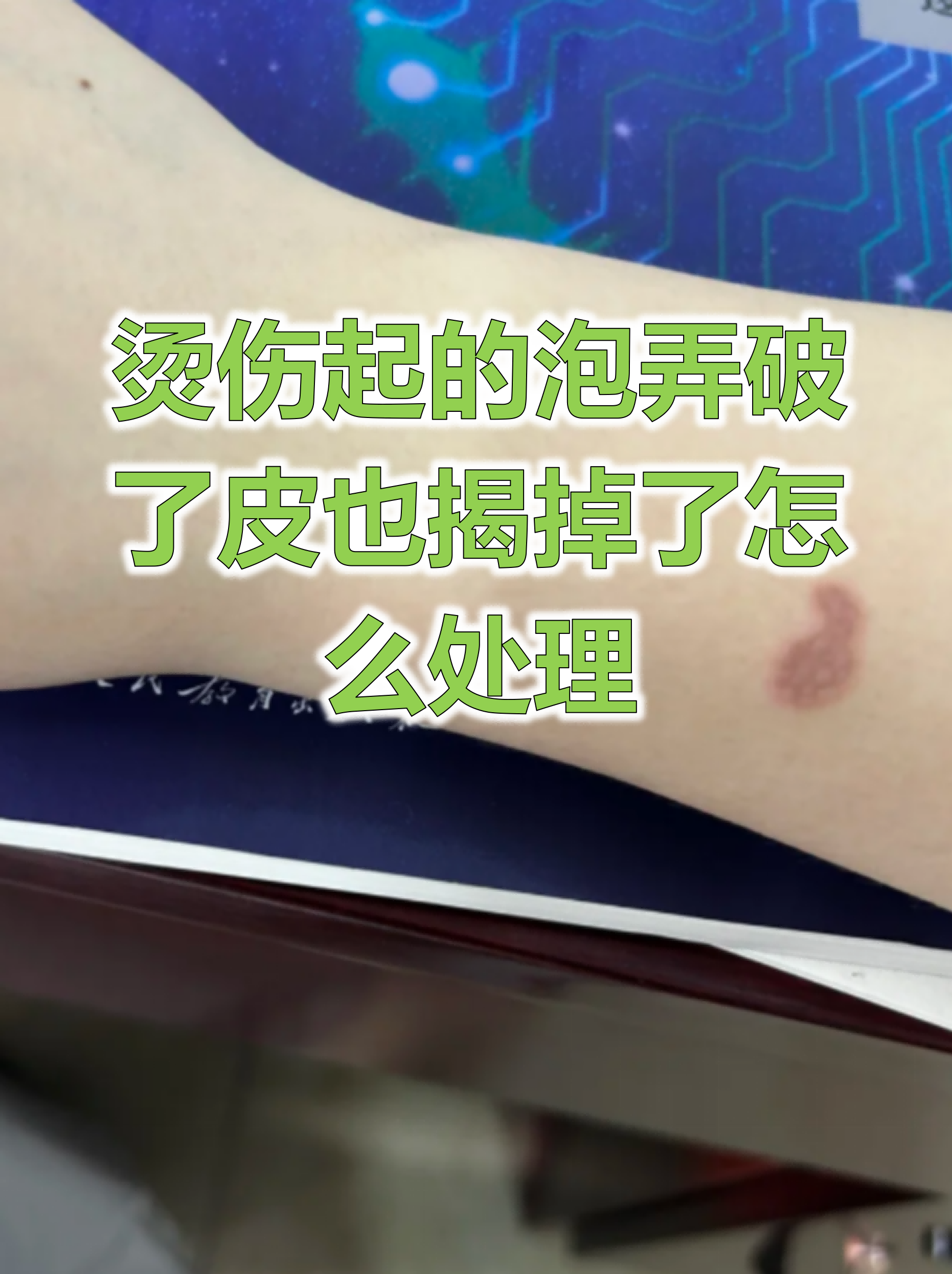 烫伤起的泡弄破了皮也揭掉了怎么处理