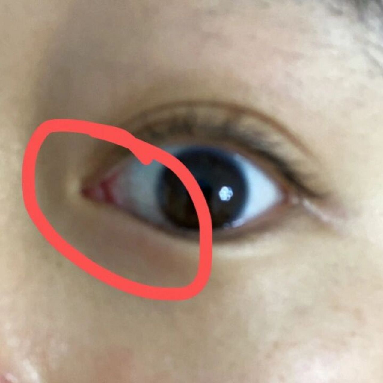 我每每一到这个季节 或者用眼太过度 我的内眼角都会爆痒!