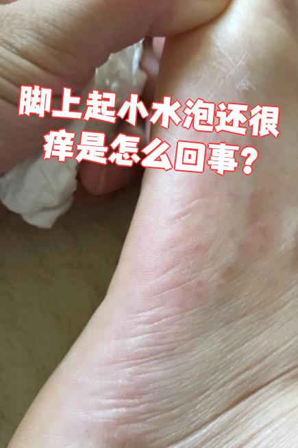 脚上起小水泡还特别痒,最常见的原因是足部湿疹,汗疱疹或者足癣