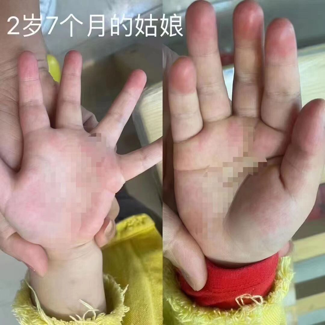 小孩子很多都有肝掌图片