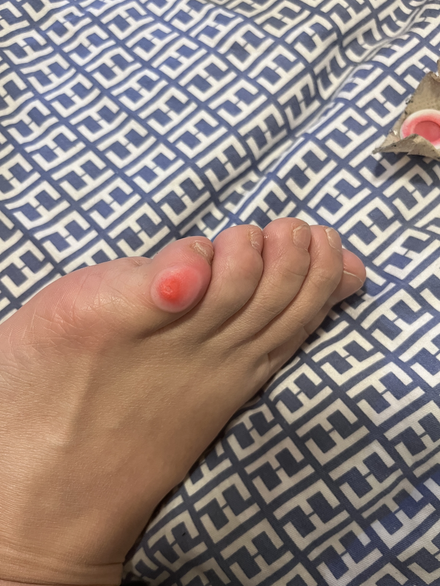 脚上长了一个鸡眼