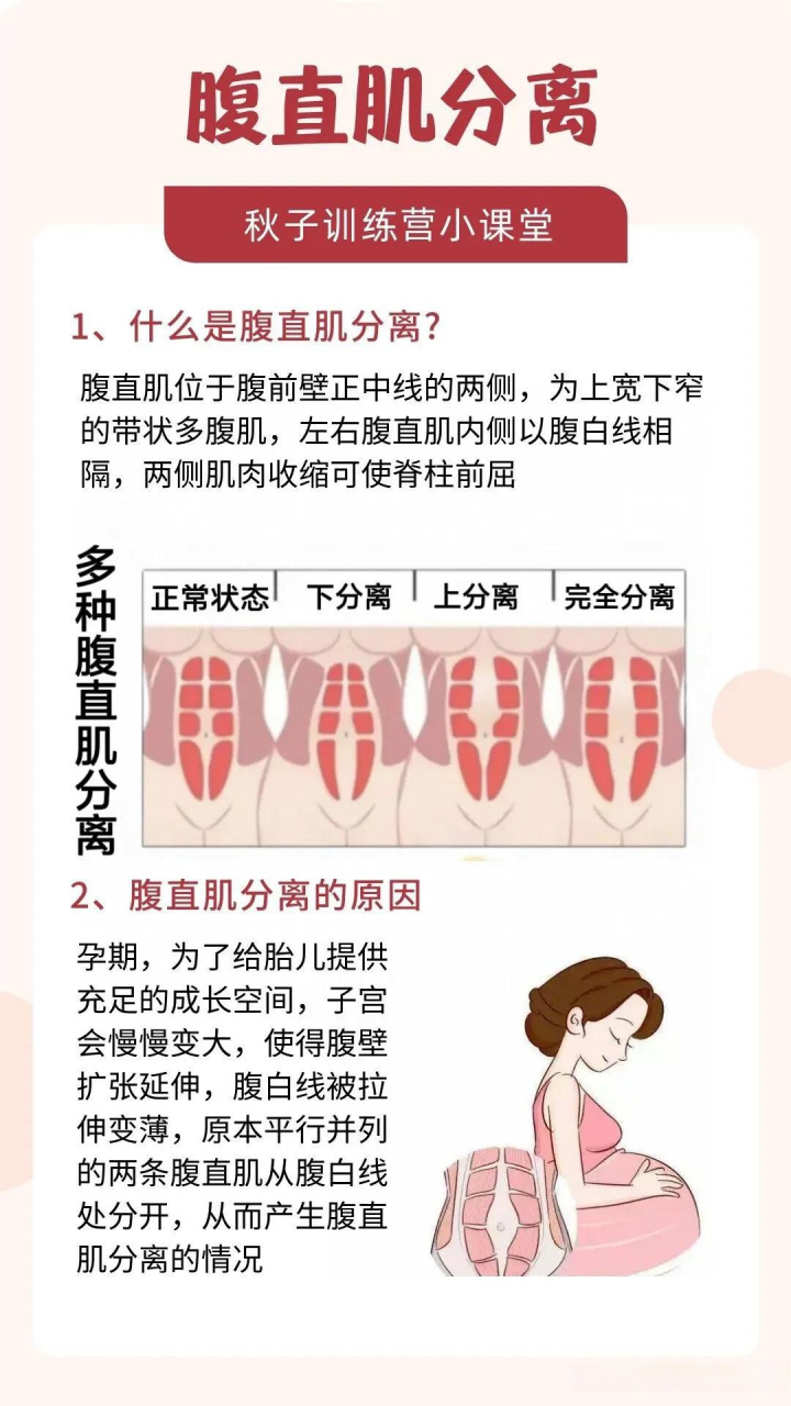 腹直肌分离2指图片