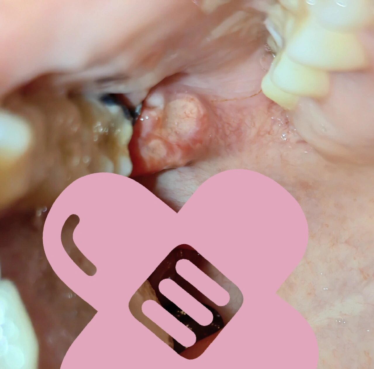 拔智齿后伤口处长溃疡了?