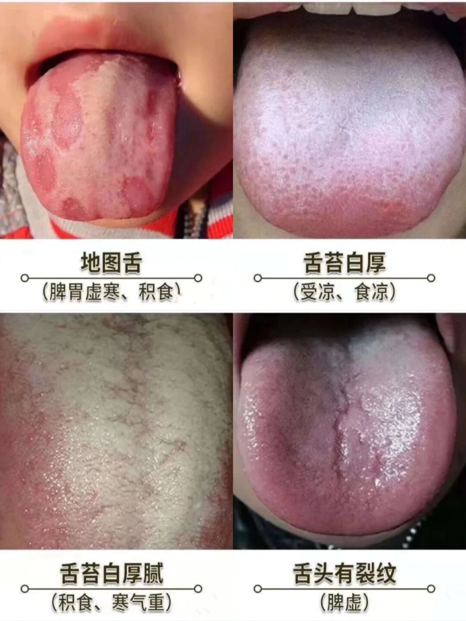 中医教你从宝宝舌苔看健康!感冒?积食?