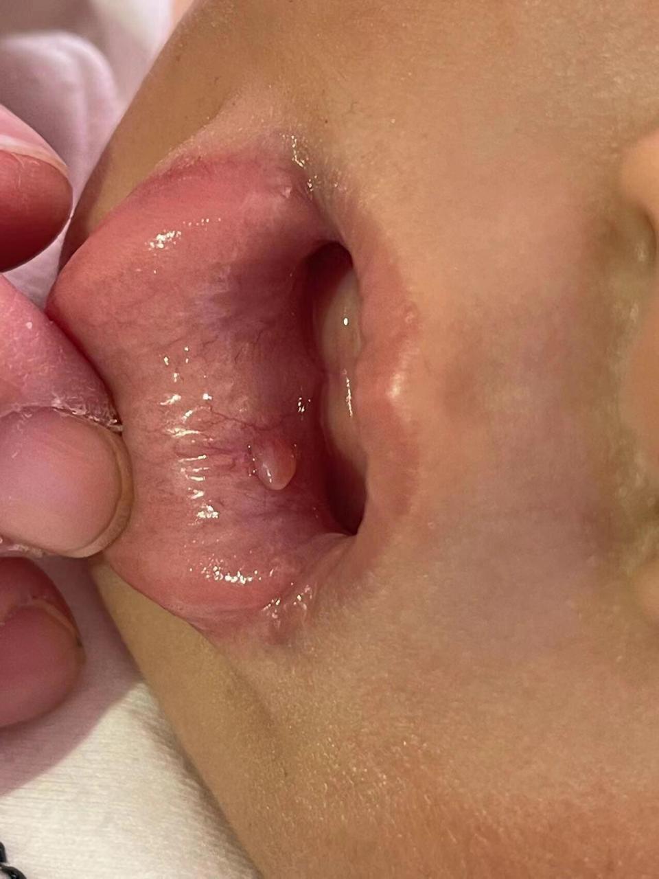 宝宝嘴里有个肉芽 九个刚九个月时候发现的,我貌似看见长鹅口疮,就给