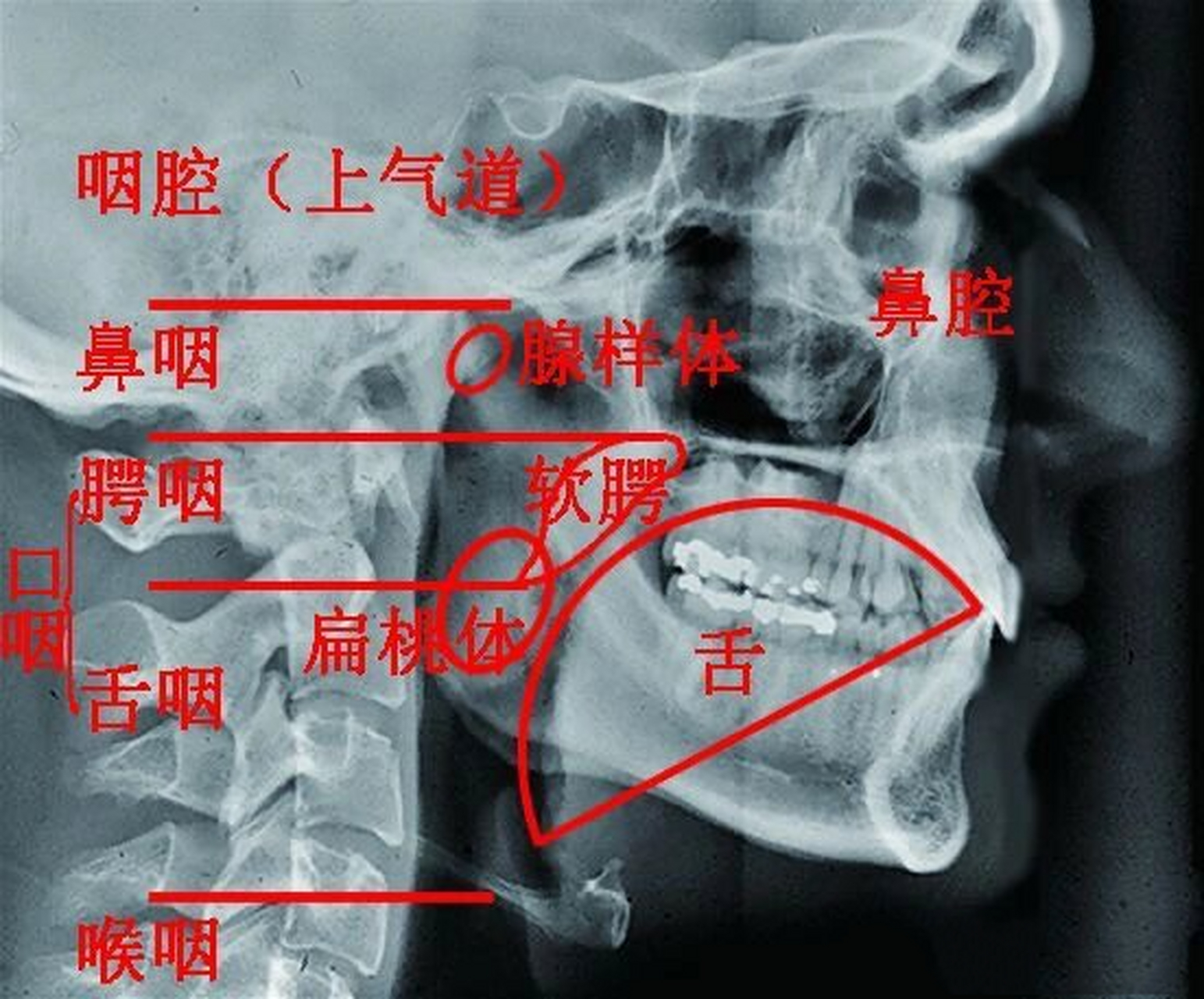 腺样体肥大的测量:首选鼻咽侧位x线片.