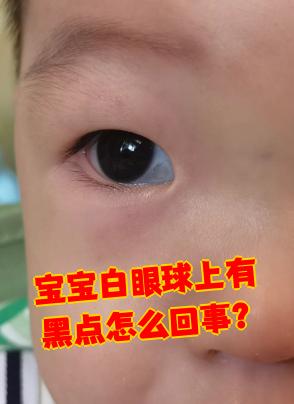 宝宝白眼球上有黑点,最常见的原因是生理性发育或色素沉着