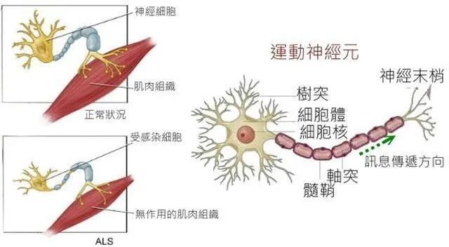 做到早期识别 慢发性肌萎缩性脊髓侧索硬化症(简称als),俗称"渐冻人"