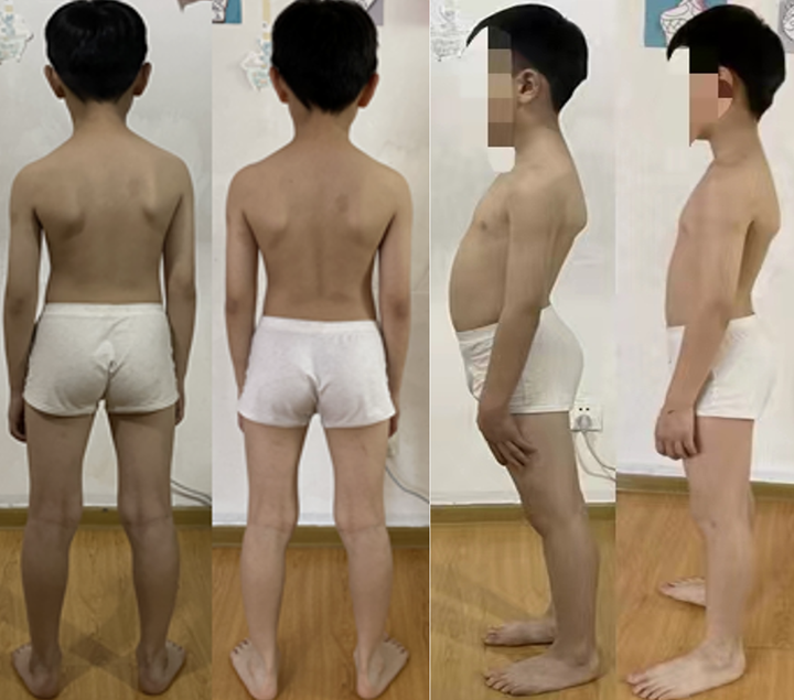 线上矫正案例九岁的小朋友轻度脊柱侧弯高低肩矫正案例