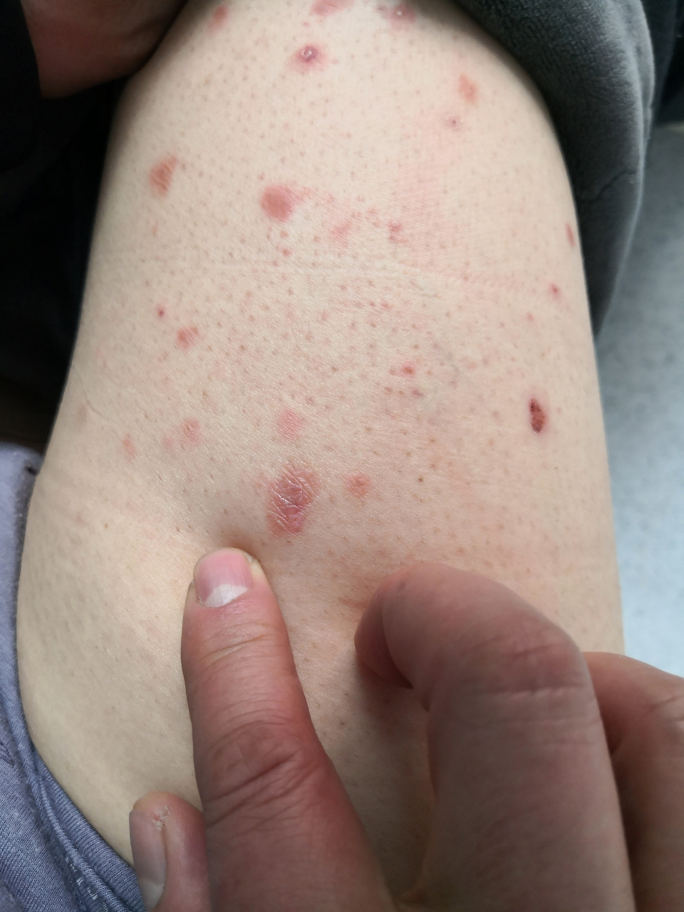 身体躯干四肢散发的鳞屑性斑块.#银屑病# 活检诊断一下比较好.