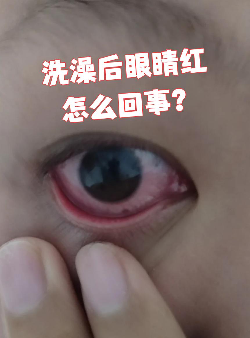 为什么眼睛红红的