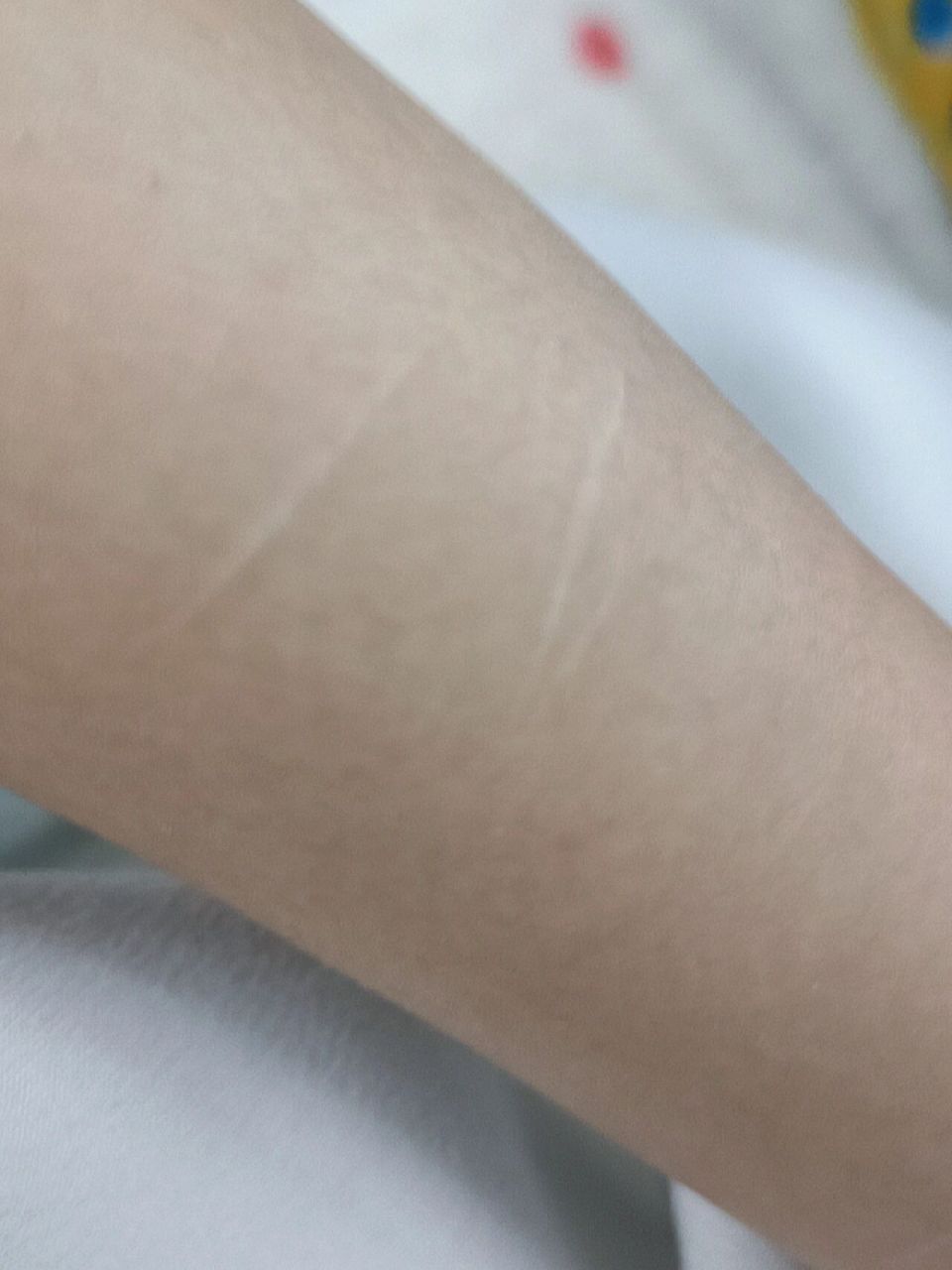 有疤可以考公务员老师嘛! 手上有疤想考公务员老师可以嘛