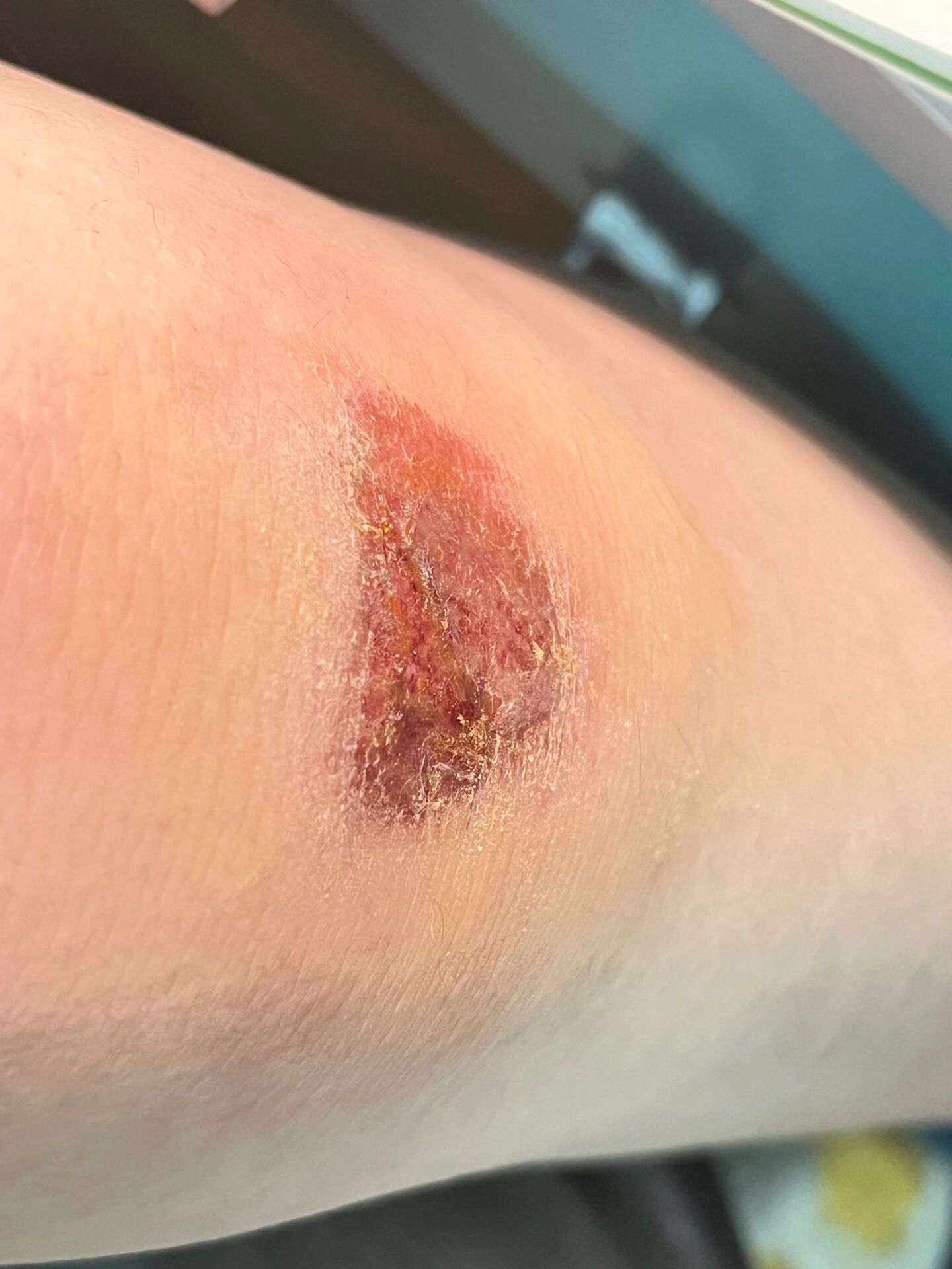 膝盖摔破五天了还没好要不要去医院啊05 周五跑步的时候摔了一跤,去