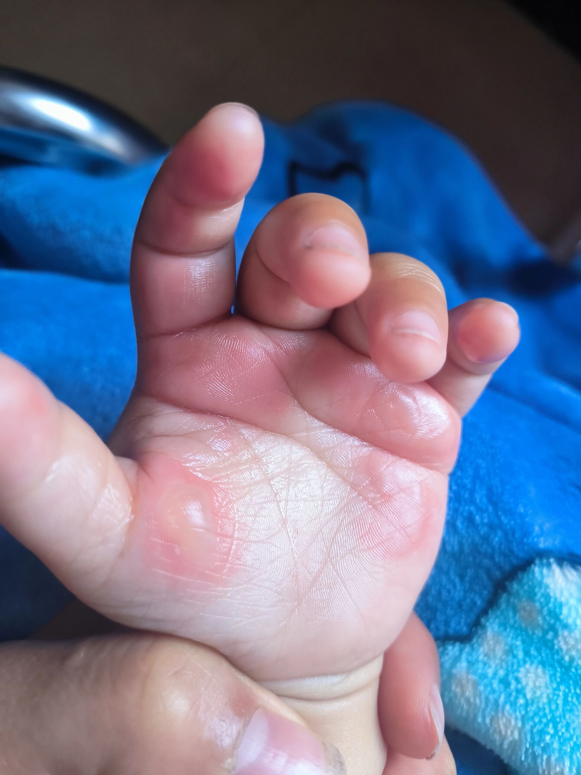 宝宝手被烫伤了,水泡要不要挑破啊