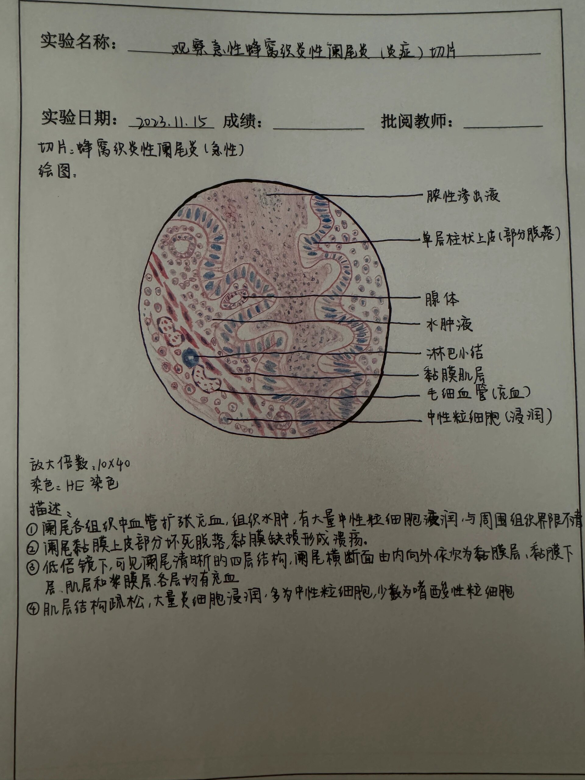 阑尾蜂窝织炎手绘图图片