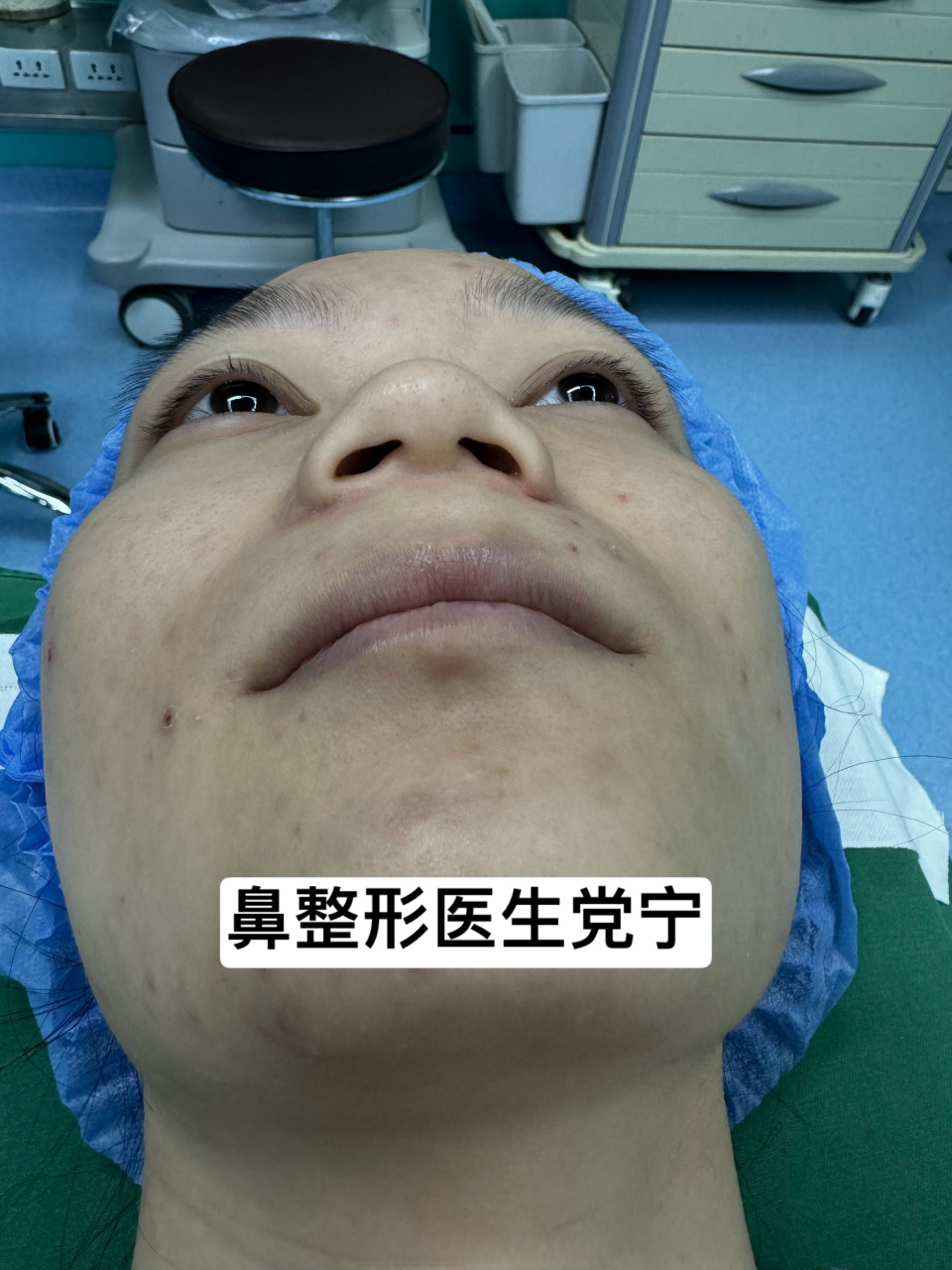 这个是我们同事,做过鼻翼缩窄以后鼻孔变小,呼吸费力,因为功能性的