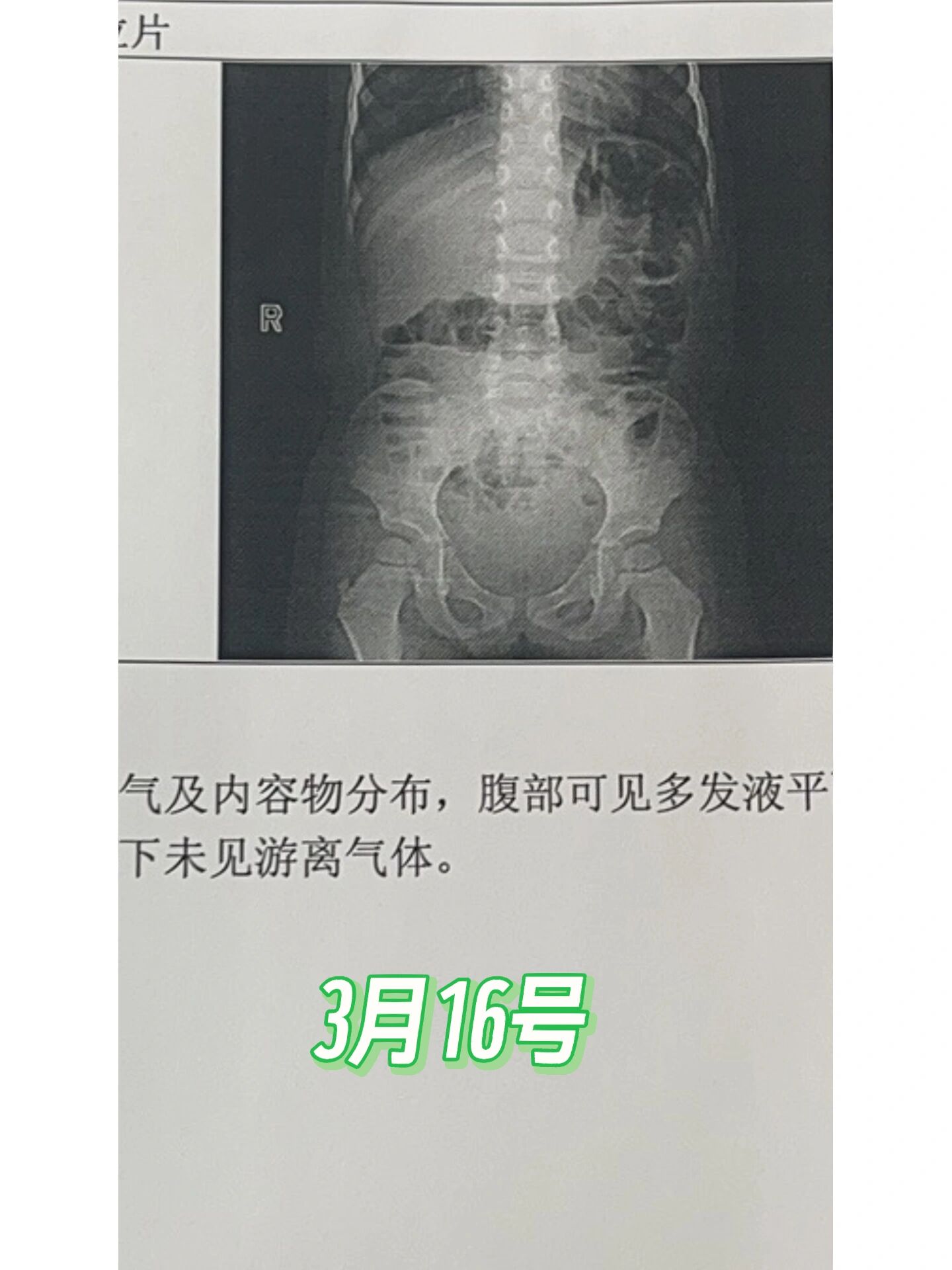 肠梗阻x线报告图片