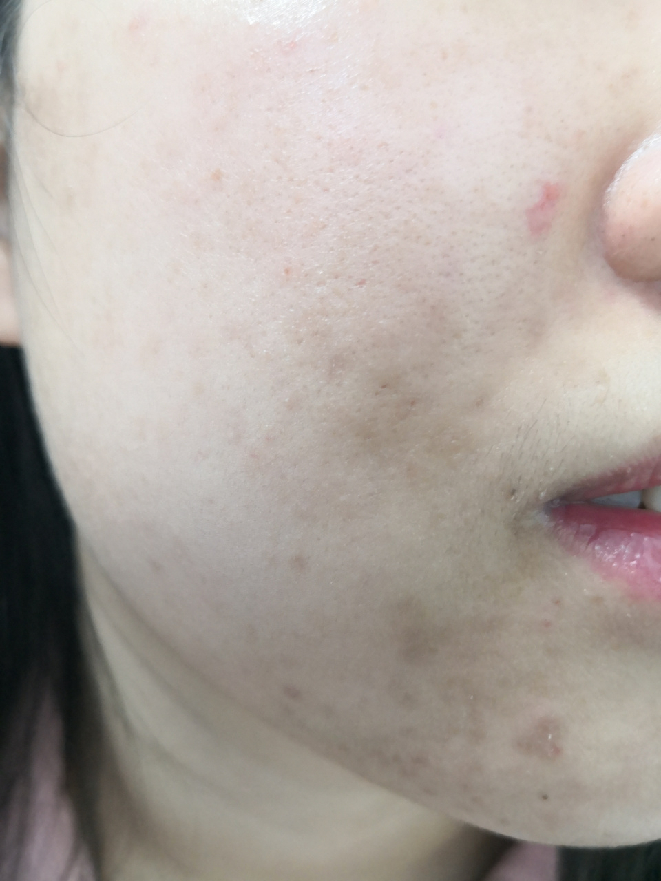 面部痤疮痘坑痘印色素沉着过度症状,需要痤疮和色素沉着过度同时治疗