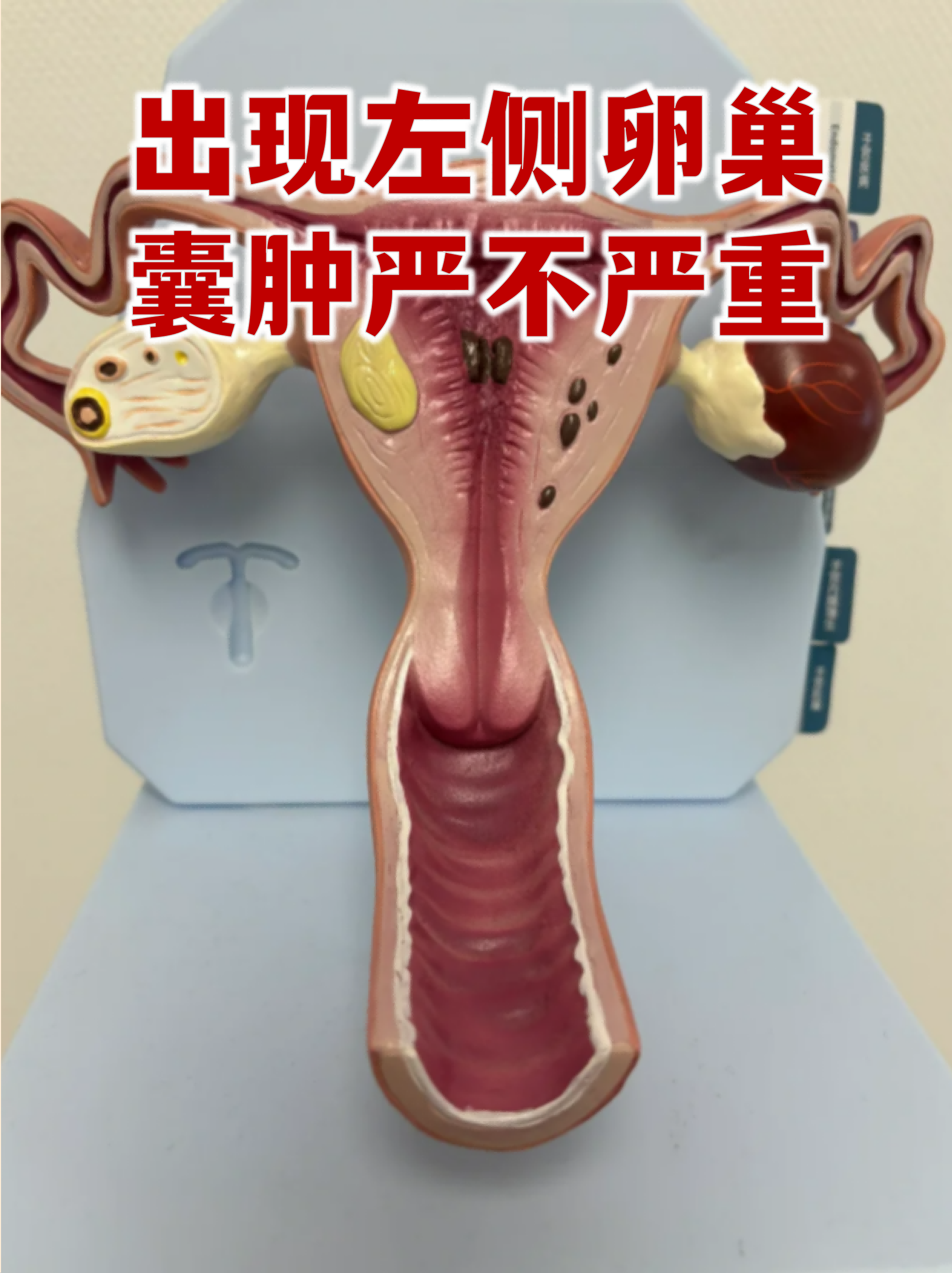 出现左侧卵巢囊肿严不严重