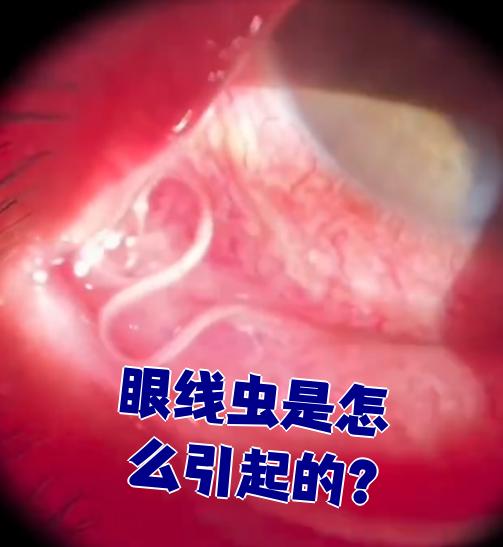 眼线虫是怎么引起的?