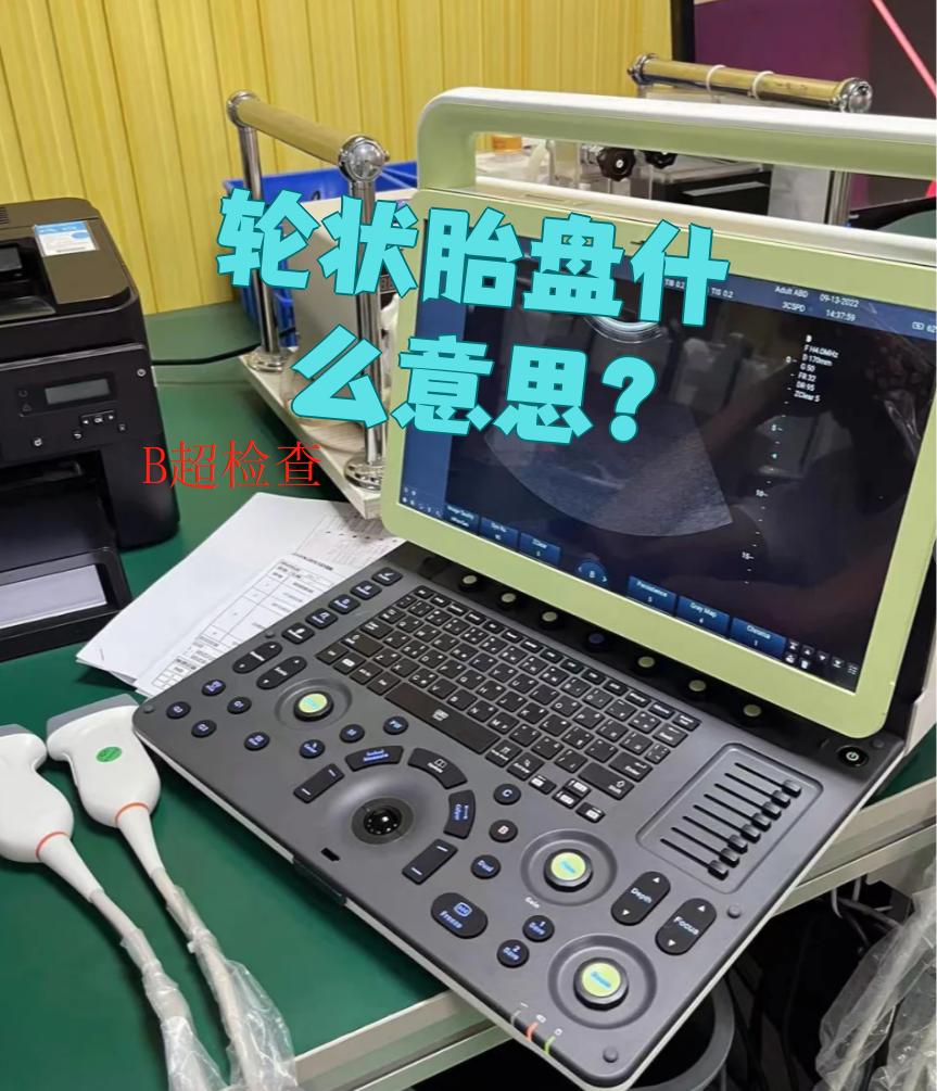 轮状胎盘什么意思?