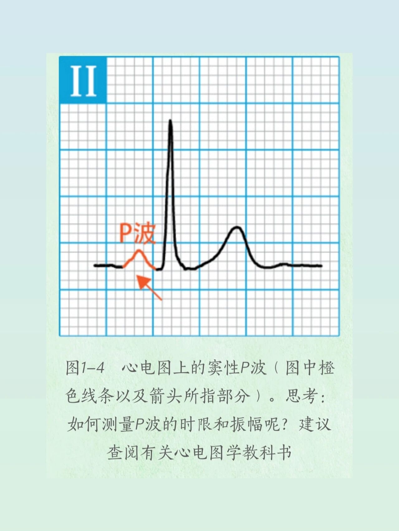 正常p波在Ⅰ,Ⅱ,avf导联直立,avr导联倒置,v1导联常为双向,v4～v6导联