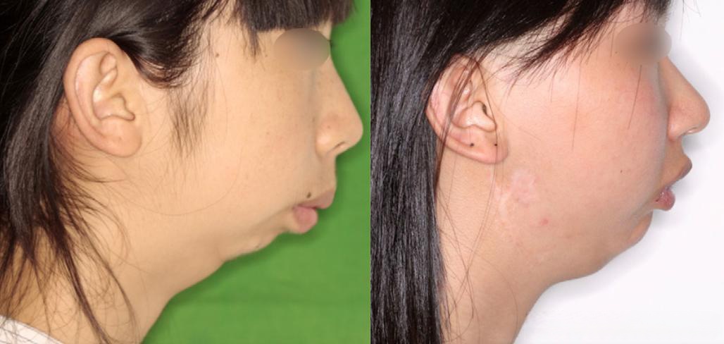 一旦他们出现下颏骨发育不良,甚至是下颌骨严重发育不良的小颌畸形