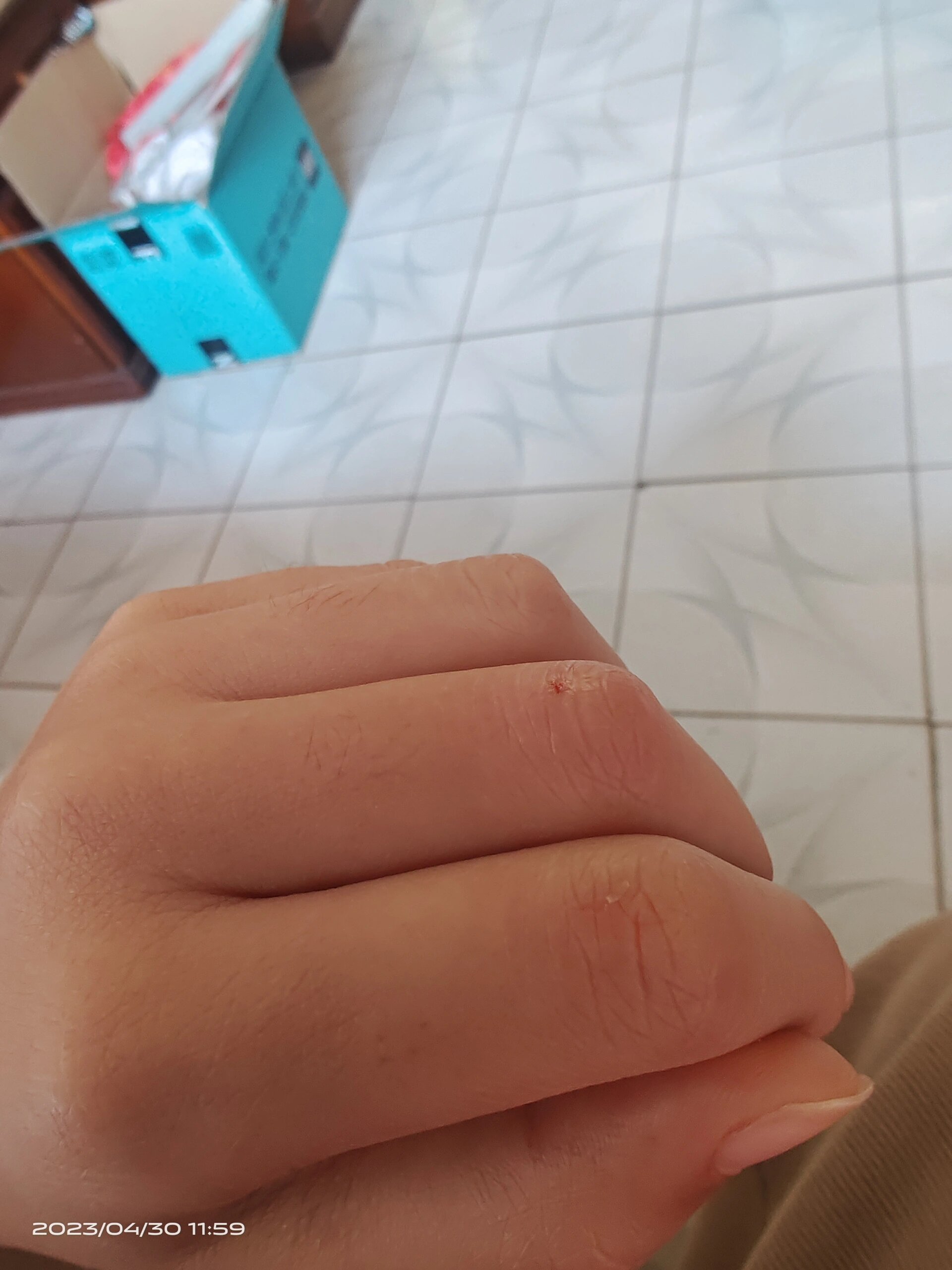 今天孩子去奶奶家喂猫的时候被猫抓伤了,已经用肥皂水洗了.