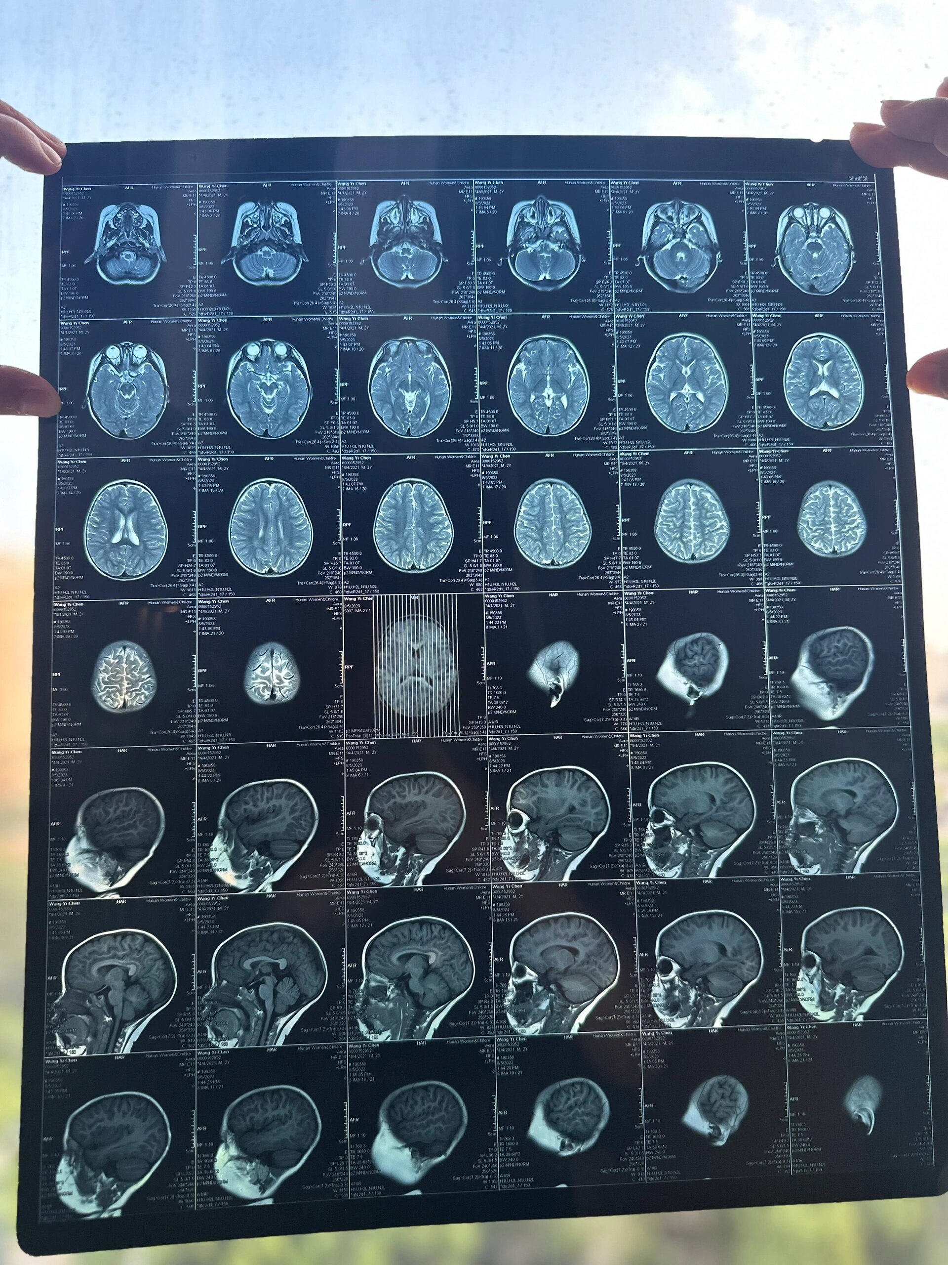 蛛网膜脑囊肿图片图片