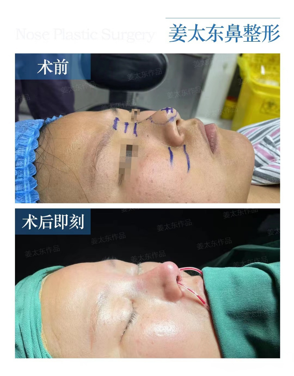 这位求美者来自江苏,术前鼻翼两侧宽,整个鼻头圆钝,没有鼻尖表现点