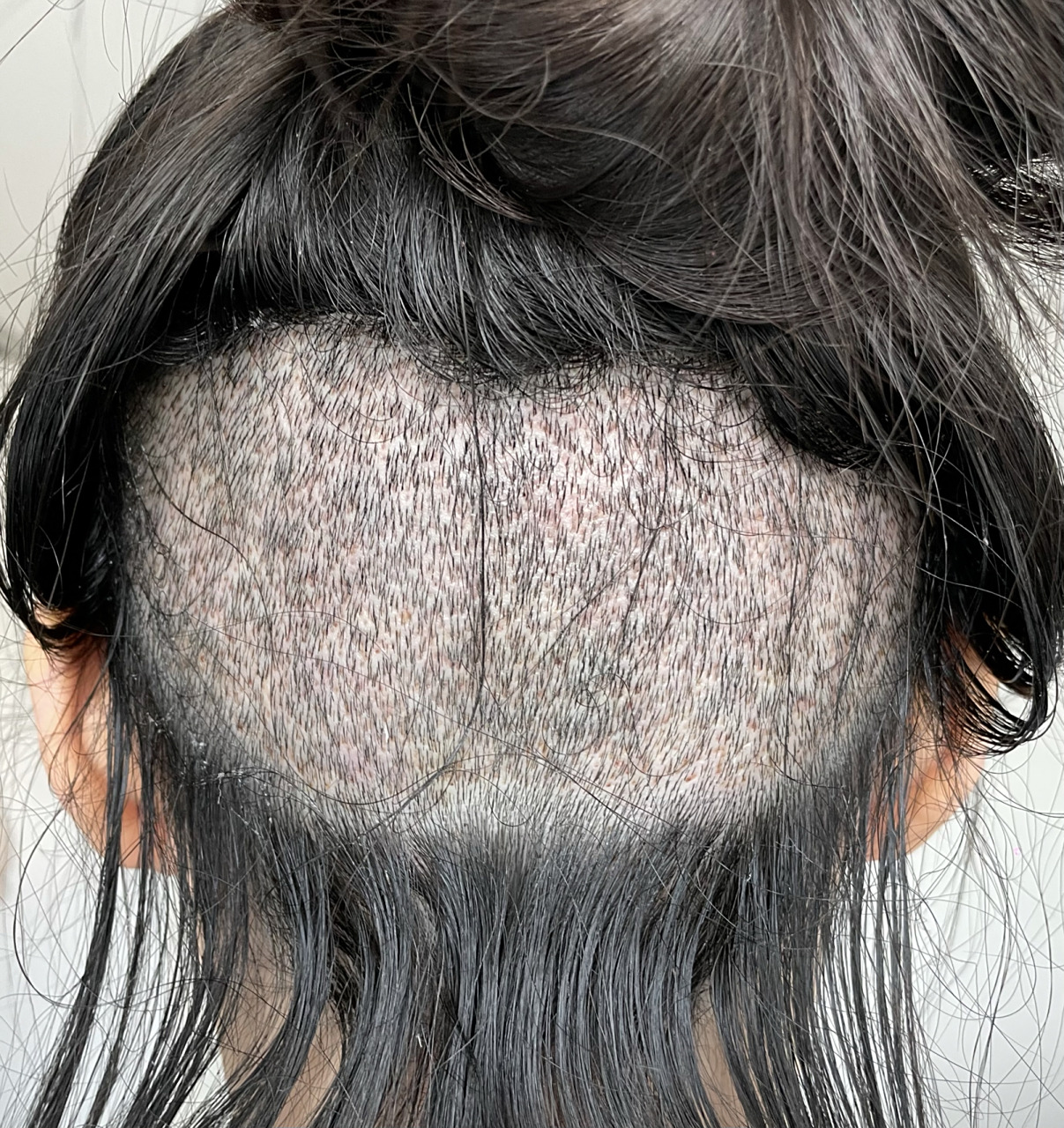 植发术后第4天98后枕部开始疼了 昨天医生刚说完可以摸种植区 但是