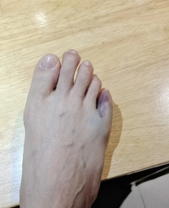 脚趾头蜷缩伸不直可能是腱鞘炎或软组织损伤导致的,具体原因需要到