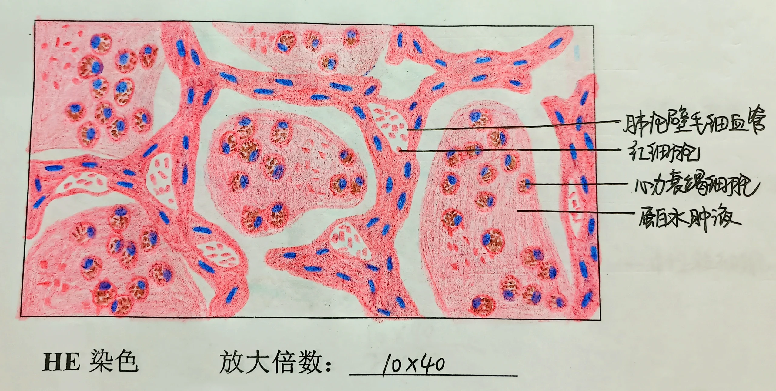 慢性肺淤血