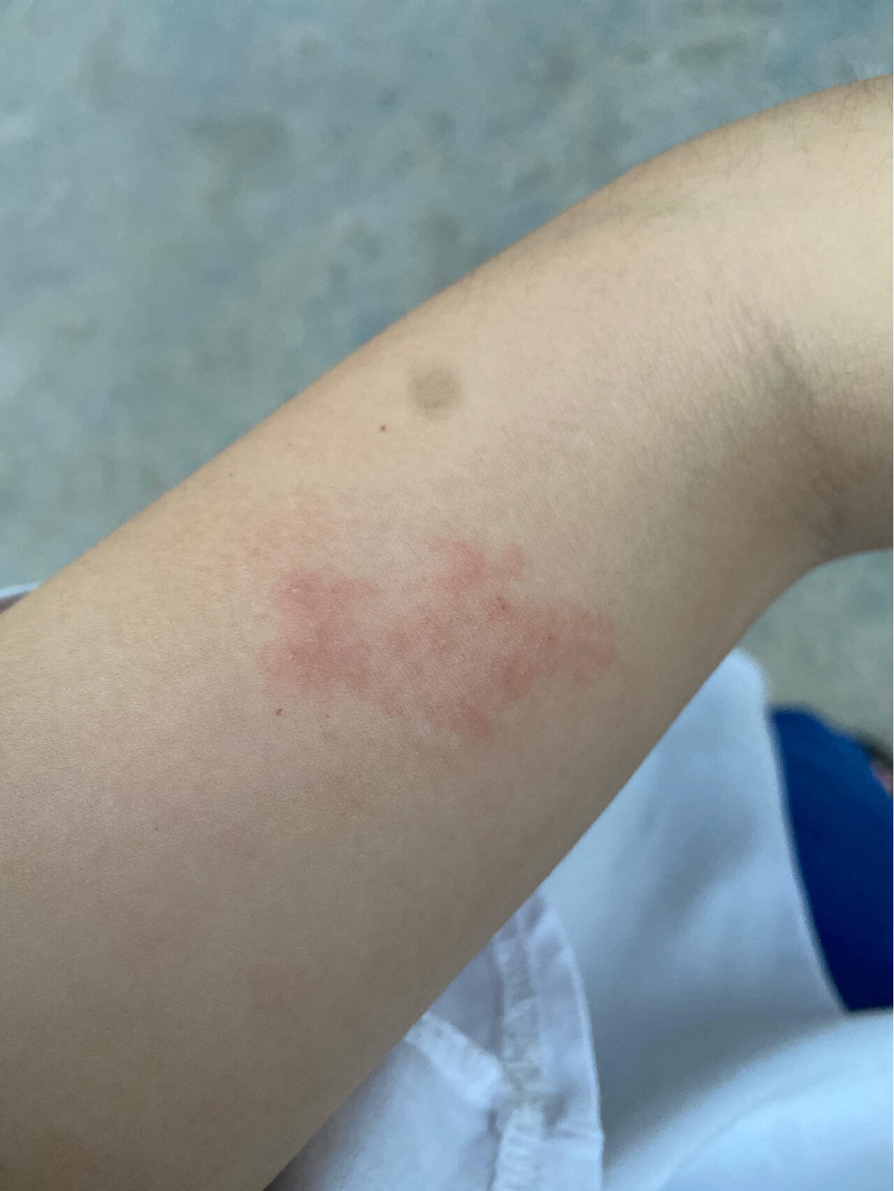 带状疱疹 我得了带状疱疹,前四天我感觉就是左手臂有一种刺痛感,想被